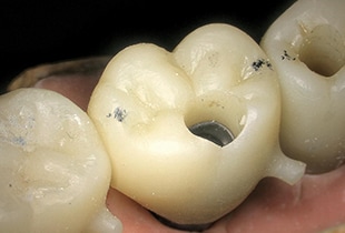 치아 임플란트의 관찰
